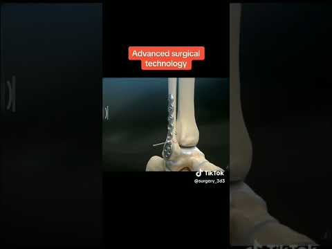 Ankle fracture fixation