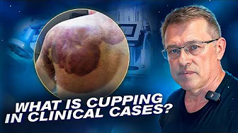 Does Cupping Therapy Work? The Pros and Cons of Vacuum Massage Therapy!