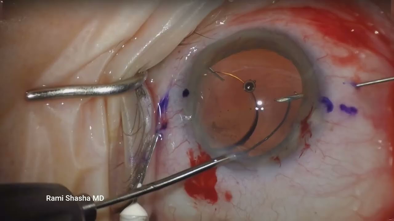 Yamane Technique - A Few Tips - Rami Shasha MD