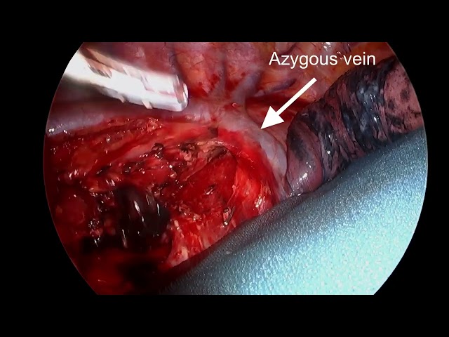 Minimally invasive ivor lewis esophagectomy: A video class=