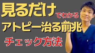 【アトピー 治る前兆】アトピー性皮膚炎いつ治るのか把握する方法！治る過程を知ってください！