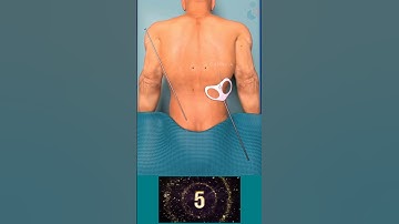 Spine Fracture Kyphoplasty ✓3D Medical Animation #Shorts #Kyphoplasty #KyphoplastySurgery #Spine