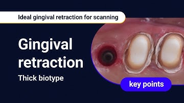 Thick biotype : Ideal gingival retraction for scanning
