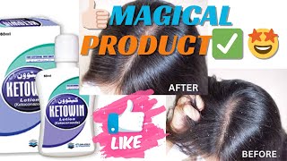 Ketowin Lotion Review | Best Solution for Dandruff & Itchy Scalp 💆‍♀️✨ 