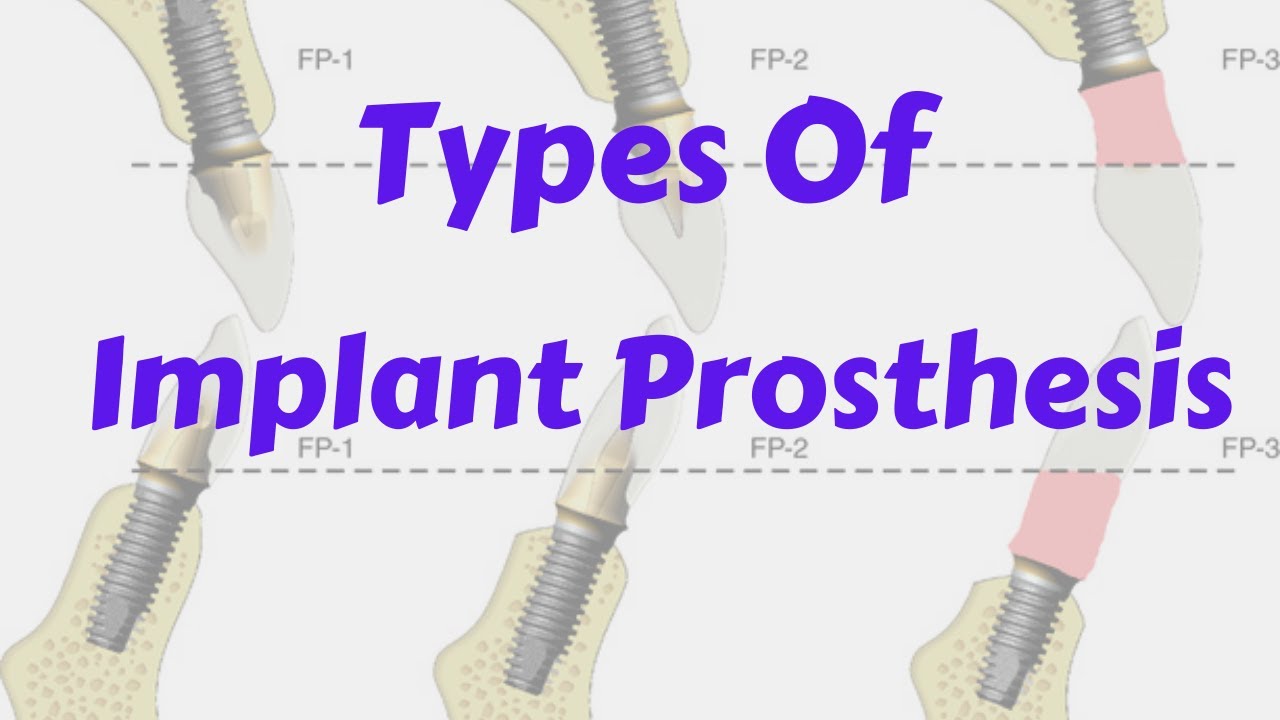 Classification Implant Supported Prosthesis Fixed, Removable, Full