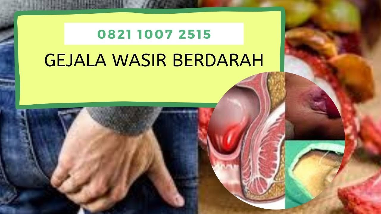 gejala wasir berdarah