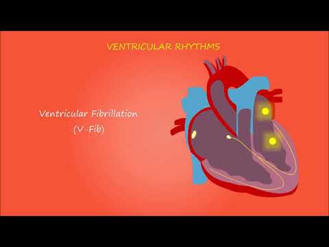 تسرع القلب البطيني: اضطرابات نظم دقات القلب البطيني : Ventricular tachycardia (VT)