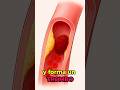 Tipos de INFARTO  #medicina #cardiovascularhealth #infarto #corazon #sintomas #bloodclots