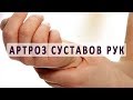 Артроз суставов рук и его лечение