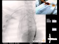 Mentice - Thoracic Endovascular Aortic Repair (TEVAR) Case Video