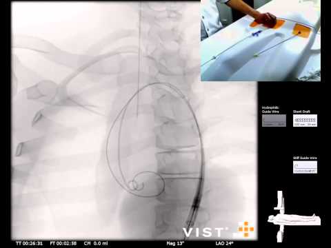 Mentice - Thoracic Endovascular Aortic Repair (TEVAR) Case Video