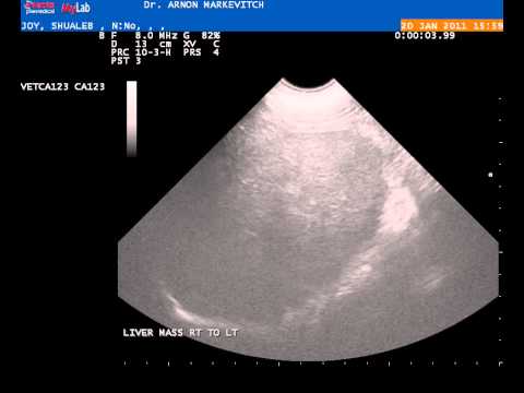 Liver hepatocellular carcinoma