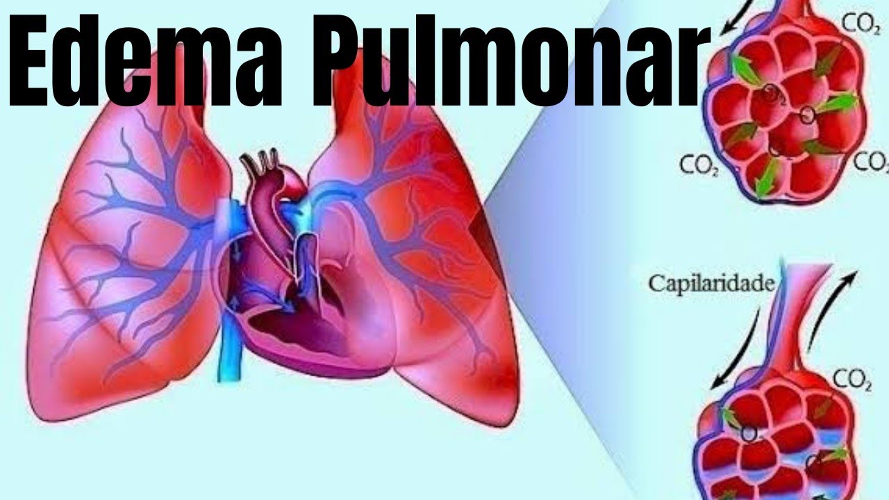O Que é Eczema Pulmonar - NAZAEDU