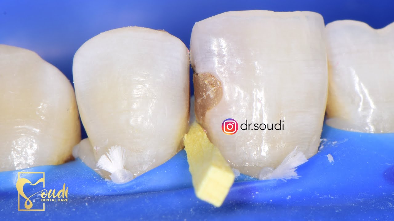 Anterior Case Discussion (class III)