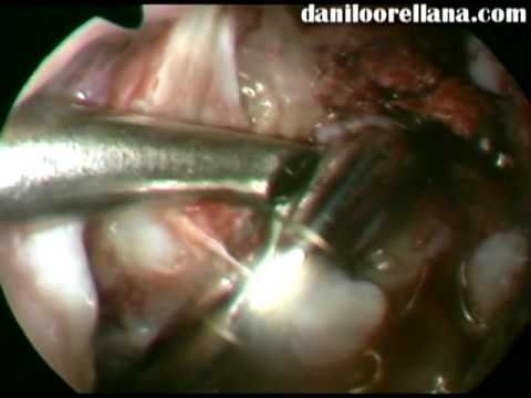 Artroscopia de Rodilla con Reparación de LCA