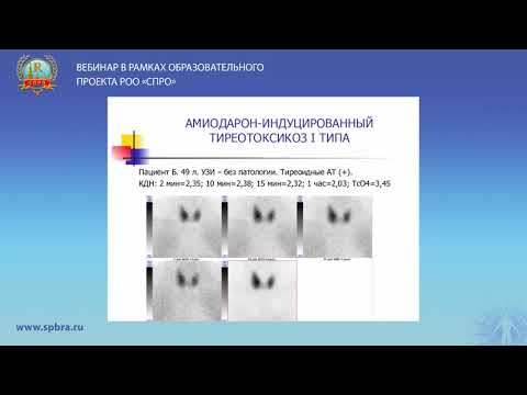 Сцинтиграфия щитовидной железы в дифференциальной диагностике амиодарон-индуцированного тиреотоксико