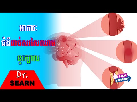 Stroke Signs and Symptoms សញ្ញាជំងឺដាច់សរសៃឈាមខួរក្បាល៖ អ្នកដឹងហើយល្អ តែអ្នកមិនដឹងត្រូវតែដឹងពេលនេះទៅ