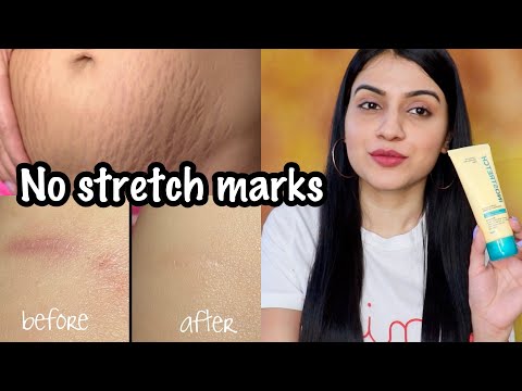How to Remove Stretch Marks | How to Remove Scars | Stretch Marks Removal Cream | Nidhi Chaudhary