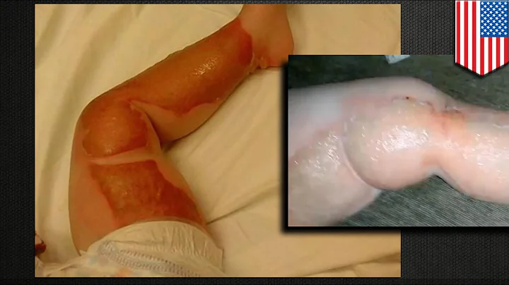 Toddler, seryosong napaso nang walang paliwanag sa...