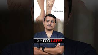 Varicose Vein Treatment When To Act?