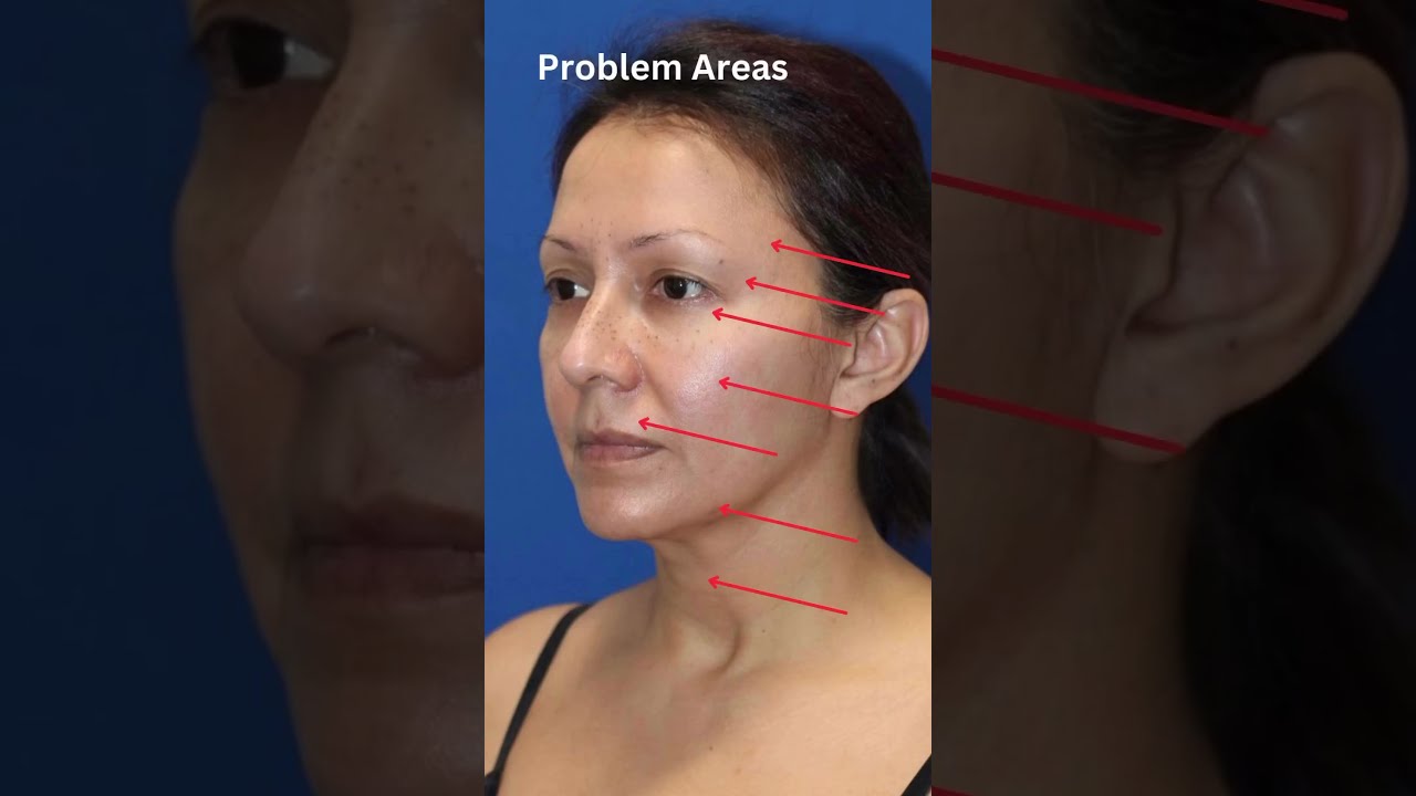DRAMATIC Facelift Before And After 