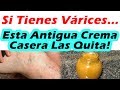 Como Quitar Varices Con Esta Antigua Crema Casera: COMO SE QUITAN LAS VARICES