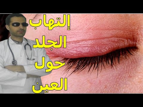 فيديو: هل يمكن أن ينتشر التهاب الجلد حول العين؟