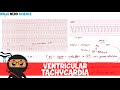 Rate and Rhythm | Ventricular Tachycardia