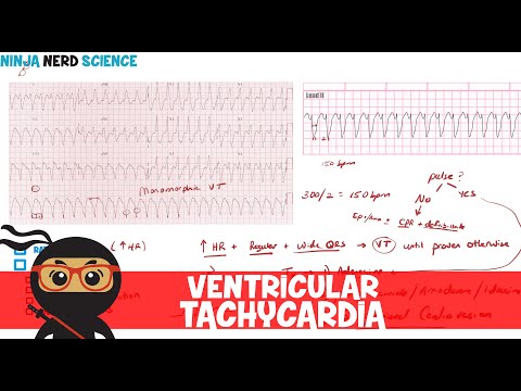 Rate and Rhythm | Ventricular Tachycardia