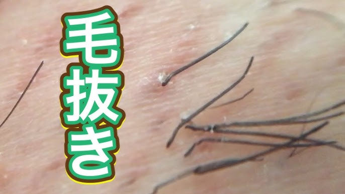生い茂った脇毛をひたすら抜く 1 5倍速推奨 Tweezers Microscope Youtube