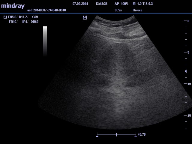 УЗИ опухоли правой почки больших размеров