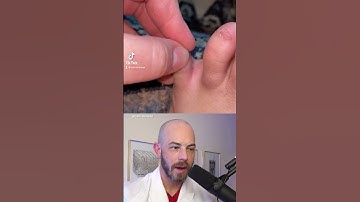 Thumbnail of Derm reacts to sneaky hair splinter! #dermreacts #doctorreacts #hairsplinter