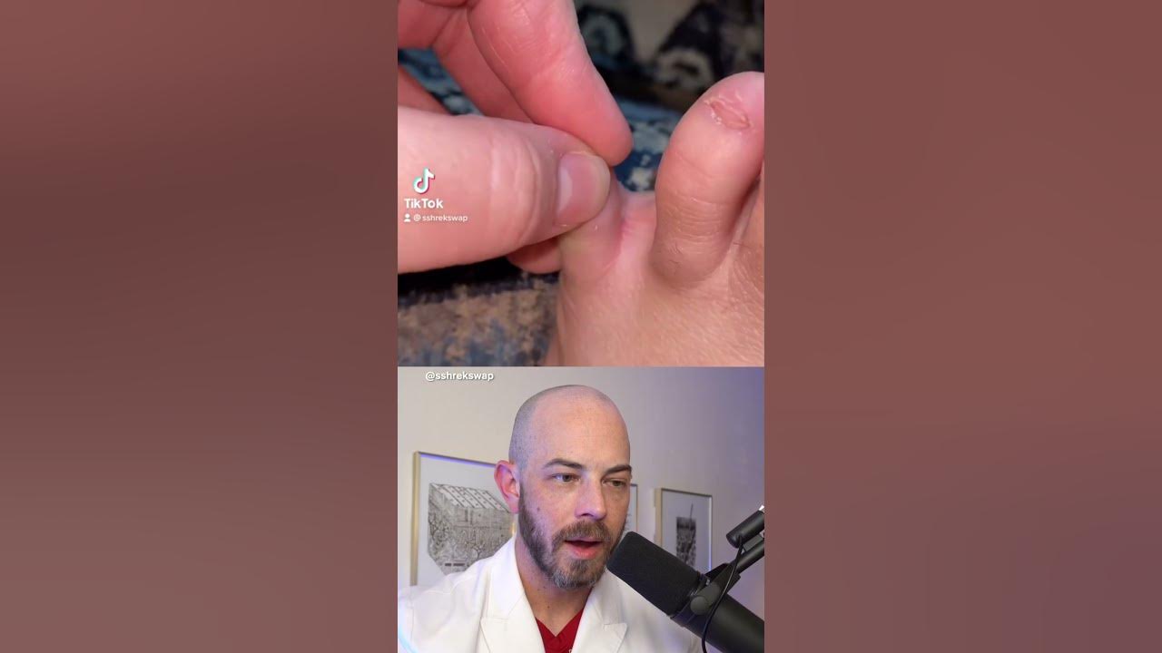 Derm reacts to sneaky hair splinter! #dermreacts #doctorreacts #hairsplinter