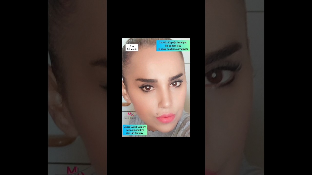 ALMOND EYES WITH UPPER EYELİD SURGERY+LIPLIFTING SURGERYDUDAK KALDIRMA AMELİYATI YouTube
