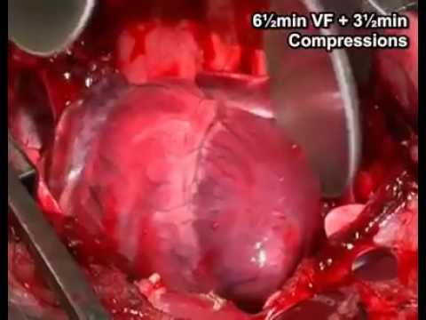 Defibrillation Of The Heart With Internal Paddles Youtube