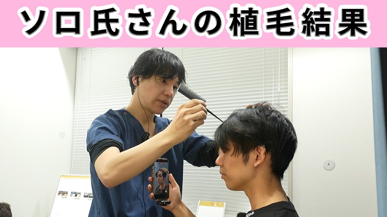YouTube更新】インフルエンサーのソロ氏さんの植毛の結果を発表します