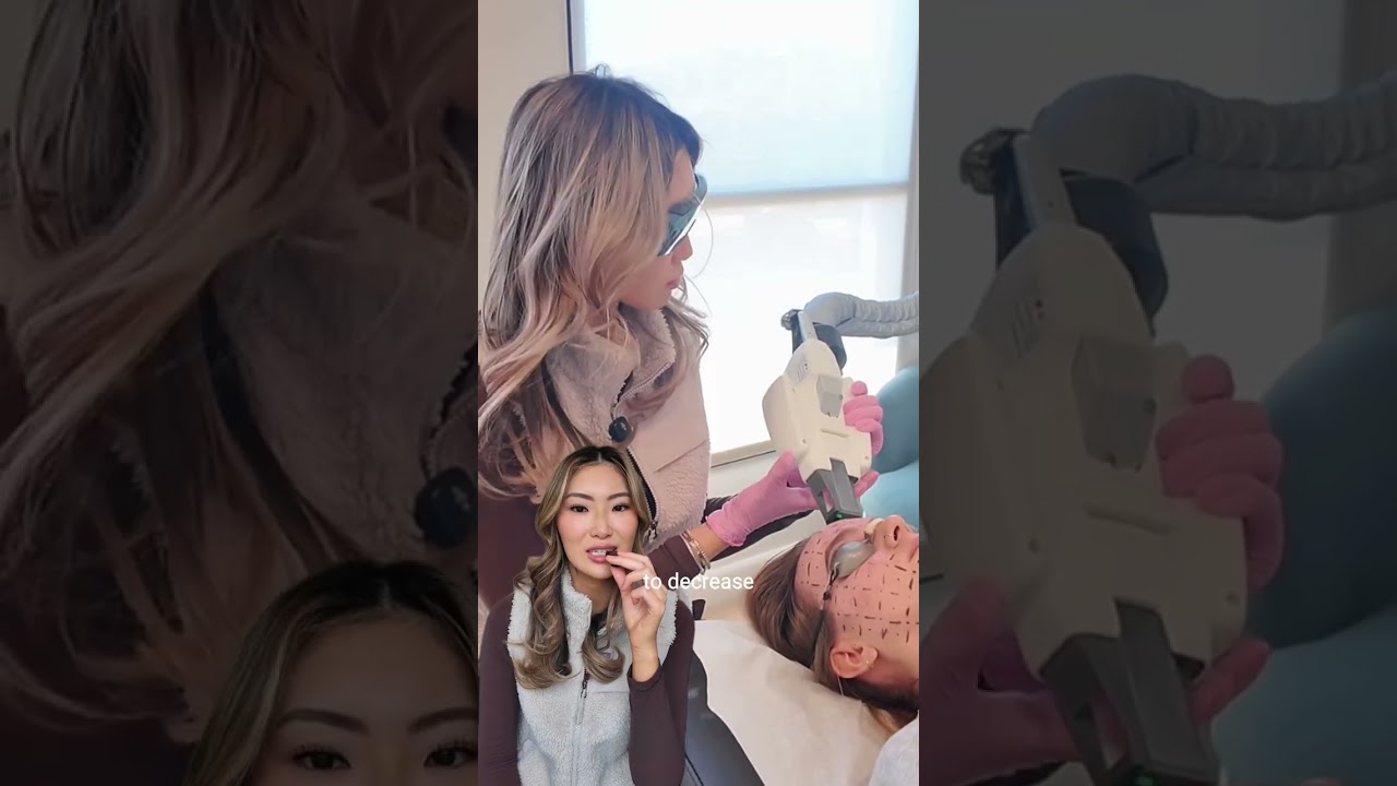 Let’s do an Accure acne laser treatment