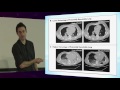 Lung Recruitment - Dr Mark Snazelle