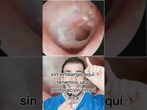 Video: ¿Cómo son los tímpanos?