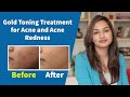 Gold laser toning treatment for acne and acne redness  dr jyoti gupta