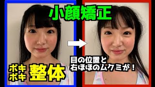 【小顔矯正／ボキボキ整体】目の位置と、頬のムクミを緩和する施術です。／注：一般の方はマネはしないで下さい