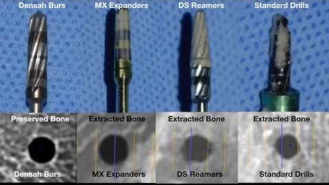 Osseodensification Biomechanical and Clinical Comparative Study