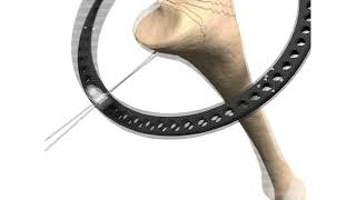 Wire Bolt Adaptor Animation - Stryker Hoffmann LRF