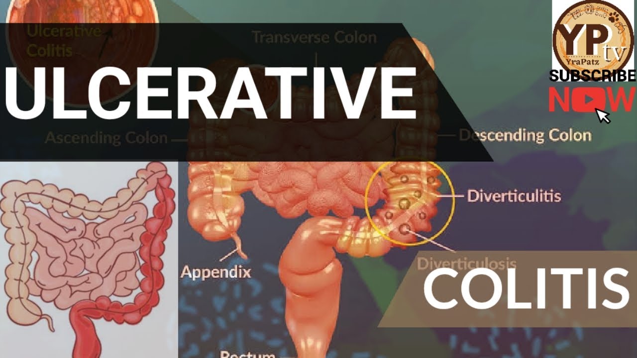 SYMPTOMS OF ULCERATIVE COLITIS? | TREATMEANT OF UC | RISK FACTORS | CAUSES OF UC