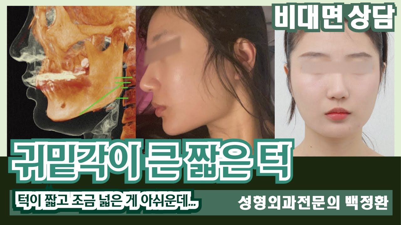 (SUB) 귀밑각이 큰 짧은 턱 [비대면상담 441] / Short chin with large underauricular ...