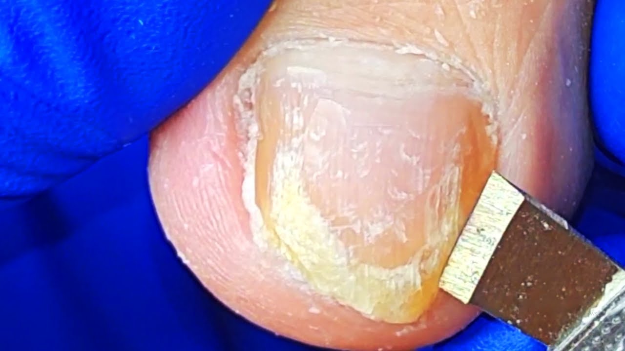 The twisted nail grows a pointy edge【Xue Yidao Pedicure】 YouTube