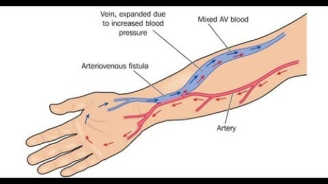 Repair Arteriovenous Fistula CPT code - simplify medical coding