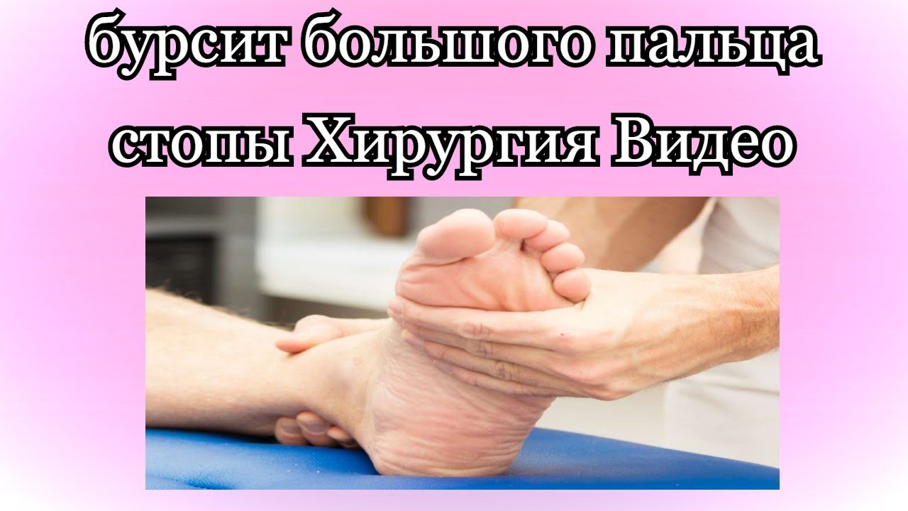 бурсит большого пальца стопы Хирургия Видео - YouTube