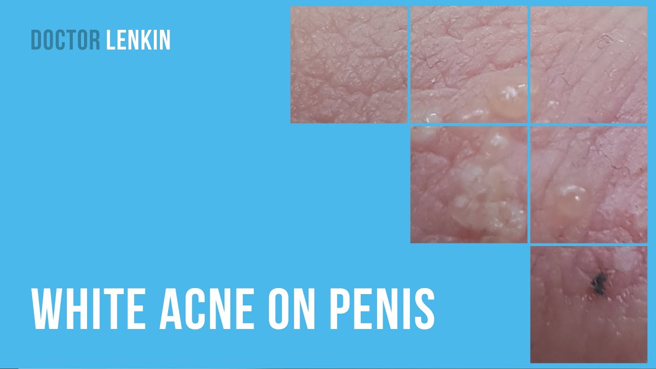 white-acne-on-penis-youtube