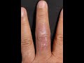 【皮膚非結核性抗酸菌症】治りの悪い手の傷は菌が原因だった!